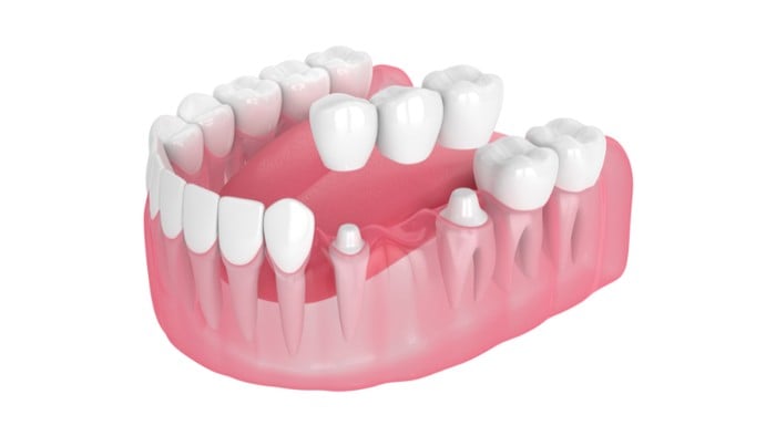 Lower-arch model with a three-unit dental bridge