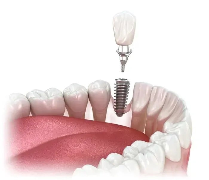 Single dental implant with crown and abutment