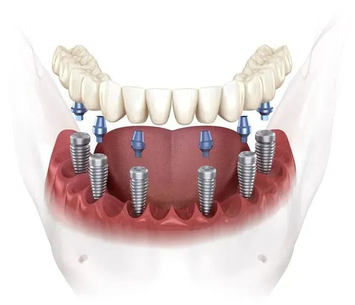 Full-arch implant restoration