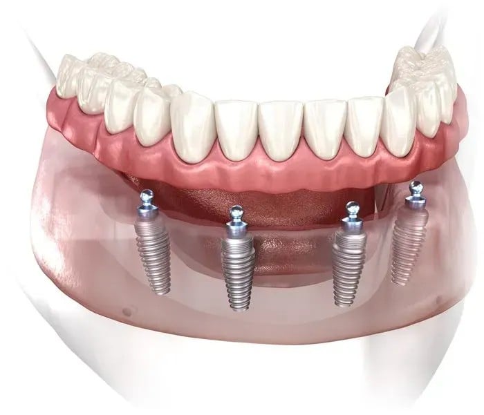 Implant-supported denture above four implants