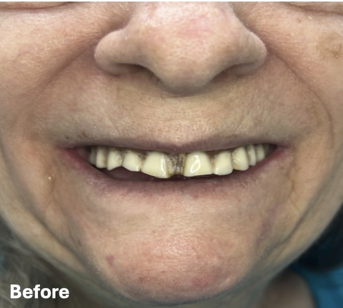 Angela, before treatment