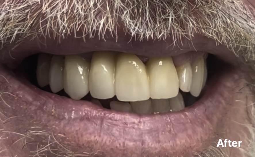 Tomas, after treatment
